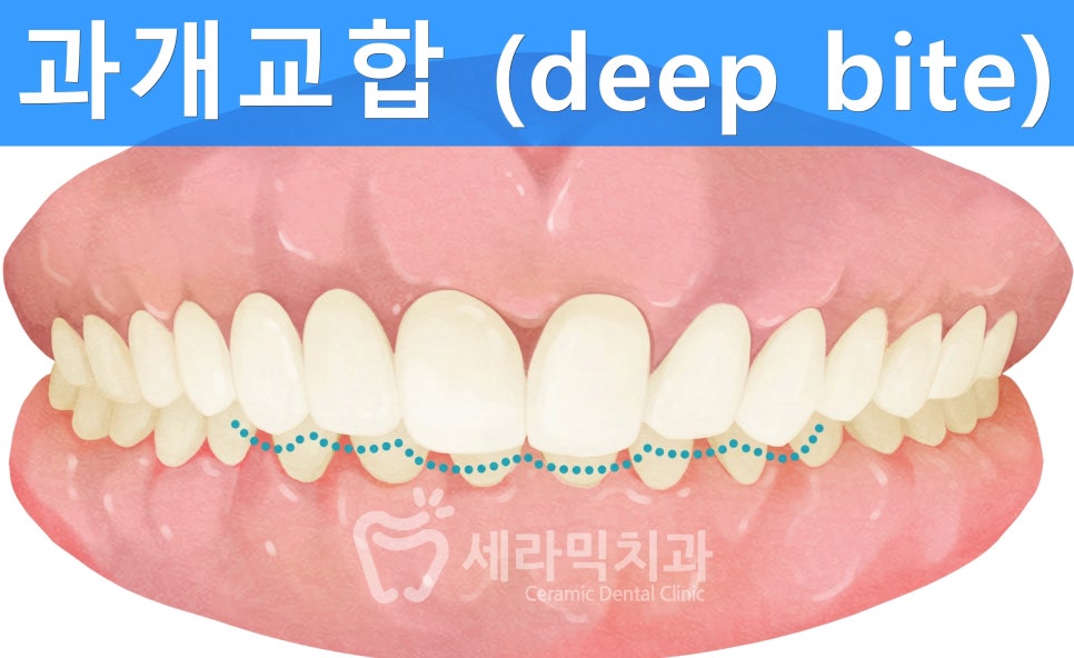 과개교합, 딥바이트 비발치 치아교정전후 관련 이미지 1