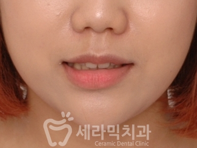 돌출입과 개방교합 치아교정 치료전후 관련 이미지 13