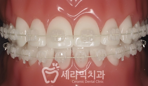 세라믹교정, 세라믹치과에서 하면 좋은 이유! 관련 이미지 2
