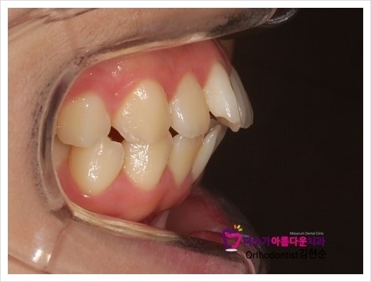 세라믹치과 돌출입교정치과 관련 이미지 2