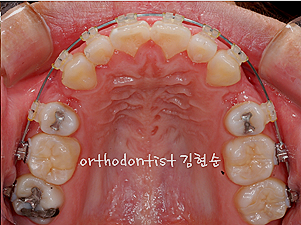 강남 돌출입 교정 관련 이미지 19