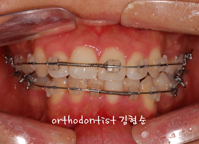 강남 돌출 관련 이미지 21