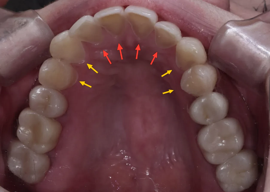 치아부식과 심미성을 동시에 잡은 앞니 치료 (ft. 역류성 식도염) 관련 이미지 8