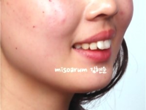 학동역 돌출입교정 세라믹치과 관련 이미지 3