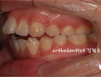 강남치아교정추천 관련 이미지 8