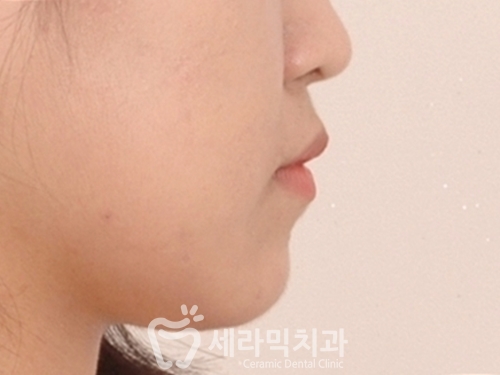 돌출입교정으로 갸름한 턱라인까지 되찾다! 돌출입 치아교정전후 관련 이미지 11