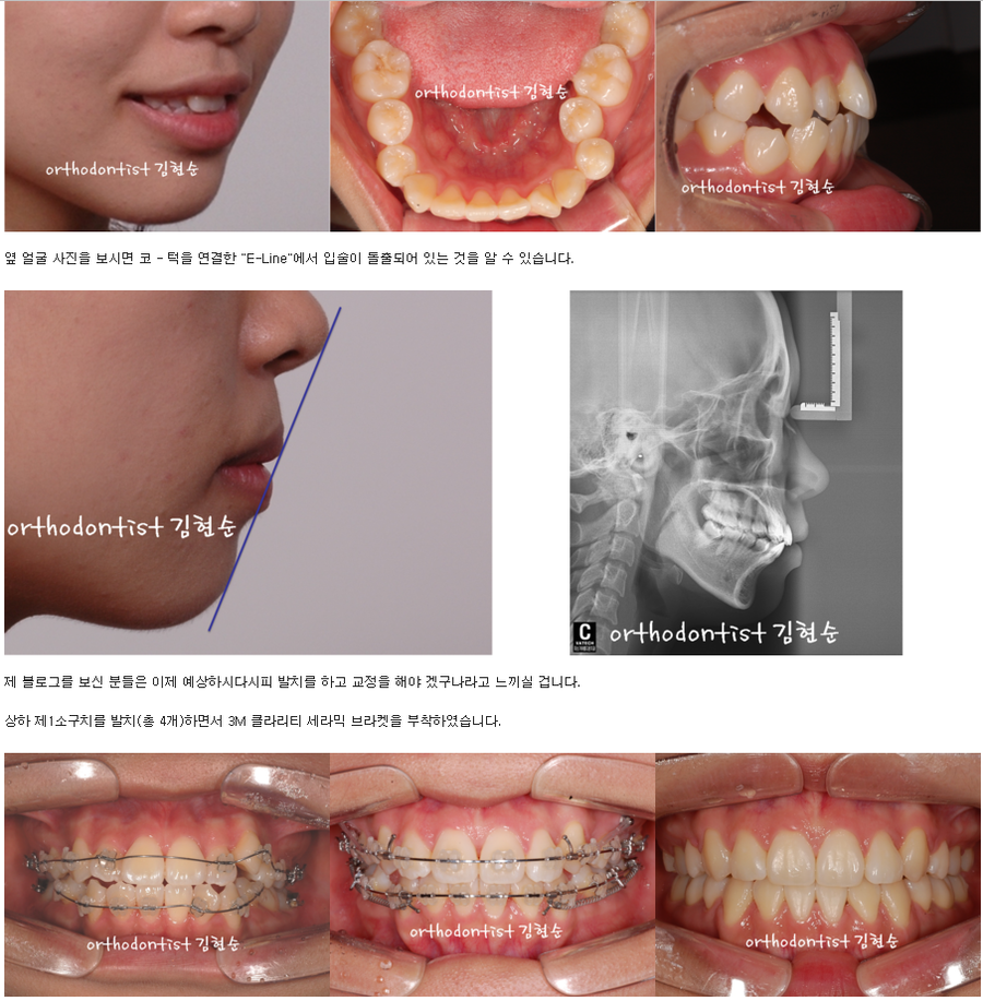 세라믹교정 세라믹치과-돌출입발치교정 4 관련 이미지 2