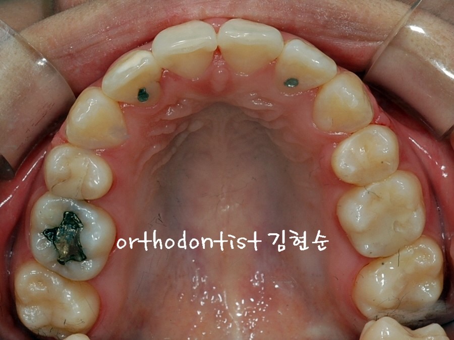 학동역치과 돌출입교정 세라믹치과에서 ~ 관련 이미지 6