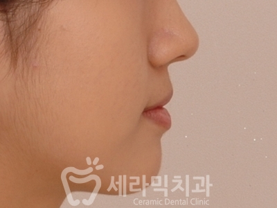 앞니 돌출, 나비치아를 남몰래 해결한 치아교정 전후! 관련 이미지 10