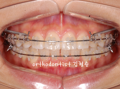 돌출 교정 (비발치 교정/비대칭) 관련 이미지 20