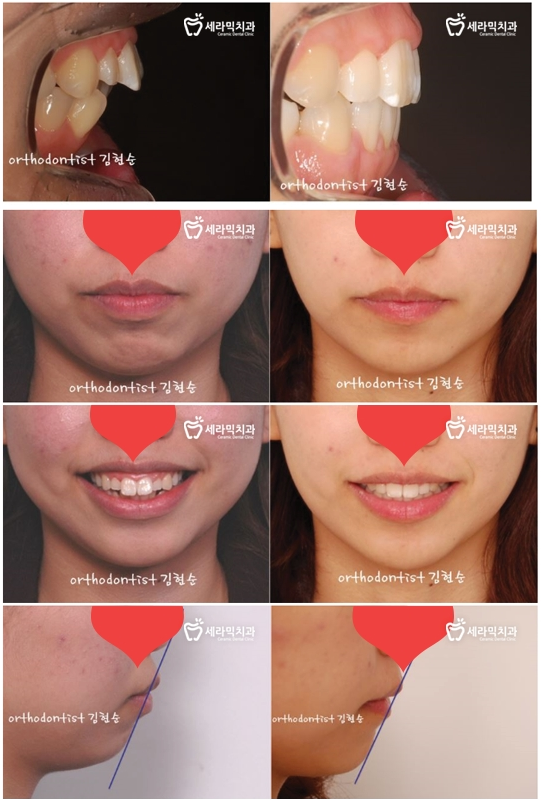 돌출 교정 월15만원 관련 이미지 10