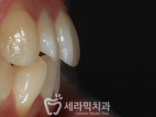 얼굴 비대칭 치아교정전후, 수술 없이 얼마나 개선될까요? 관련 이미지 4