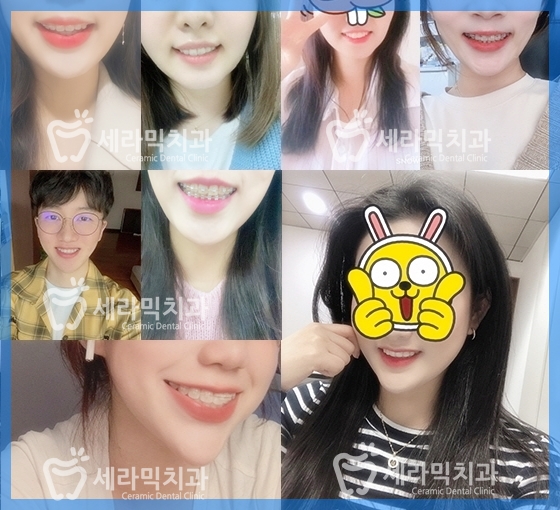 혀내밀기 습관과 개방교합, 오픈바이트(Open bite) 치아교정전후 보기 관련 이미지 12