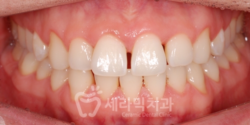 20대 남자 앞니벌어짐 개선사례, 성인 치아교정전후 달라진 Smile~ 관련 이미지 4