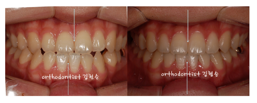 주걱턱수술 안하고 양악수술 안하고 관련 이미지 15