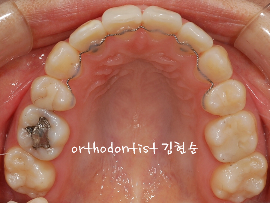 학동역치과 돌출입교정 세라믹치과에서 ~ 관련 이미지 7