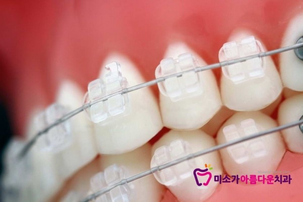 강남교정전문치과 미소가아름다운치과의 세라믹교정 [세라믹교정,강남세라믹교정,미소가아름다운치과] 관련 이미지 3