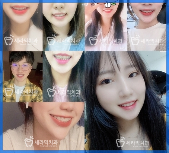 과개교합과 돌출입 개선으로 달라진 인상, 세라믹치과 치아교정전후! 관련 이미지 13