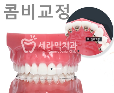 앞니 돌출, 나비치아를 남몰래 해결한 치아교정 전후! 관련 이미지 2