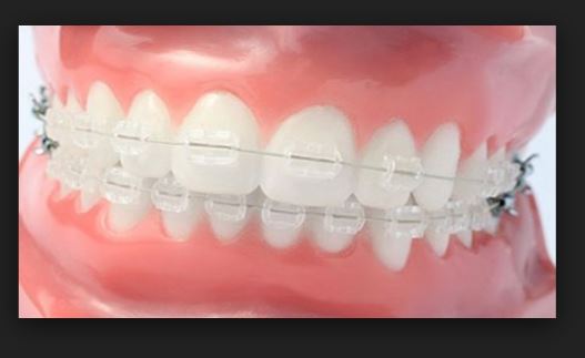 치아교정 부작용 세라믹교정 관련 이미지 2