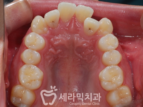 치아배열 치아교정전후 : 함박웃음을 찾은 사례 관련 이미지 4