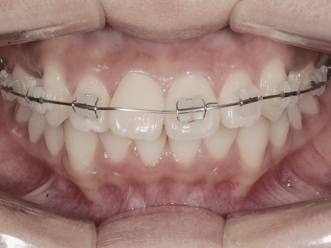 학동역치과 하면 세라믹교정 ~ 관련 이미지 17
