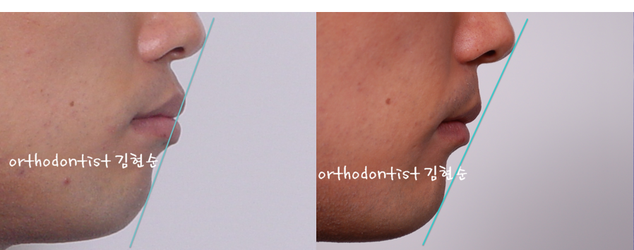 세라믹교정 세라믹치과-돌출입발치교정 1 관련 이미지 10