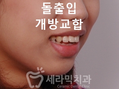 돌출입과 개방교합 치아교정 치료전후 관련 이미지 1