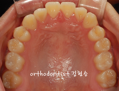 반대 교합 관련 이미지 7