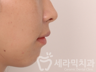 무턱교정, 거미스마일 교정 잘하는 학동역 세라믹치과 관련 이미지 6