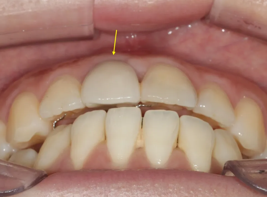 A Case of Improving the Smile Line Along with Replacing a Front Tooth Crown image 5