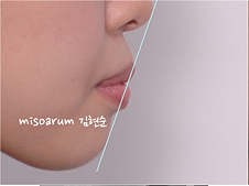 강남 돌출입 교정 관련 이미지 19