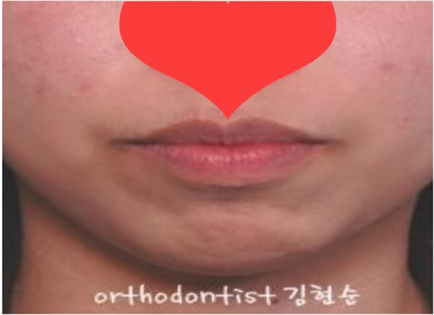 돌출 교정 월15만원 관련 이미지 5