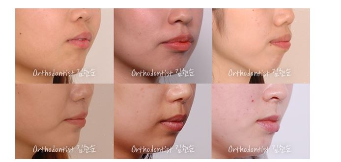 학동역치과 치아교정은 여기서 !! 관련 이미지 14