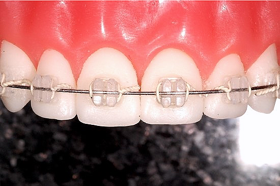 강남 세라믹 교정 관련 이미지 2