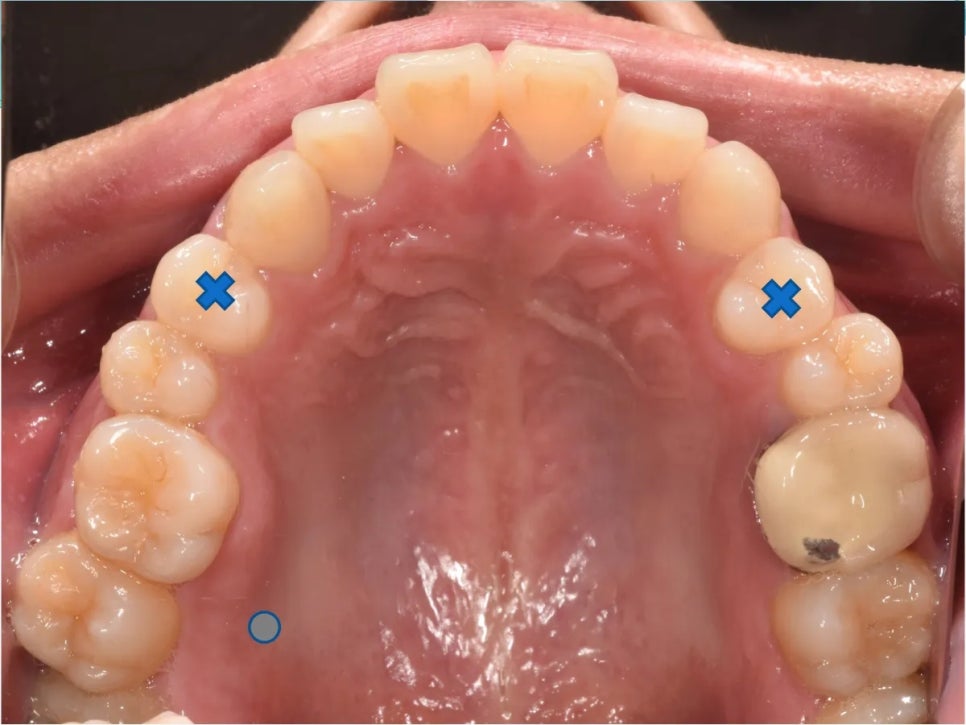 돌출입 교정 전후, 그런데 과개교합까지 있으셨던 환자분 관련 이미지 9