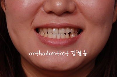 반대 교합 관련 이미지 3