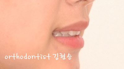 강남 덧니 관련 이미지 30