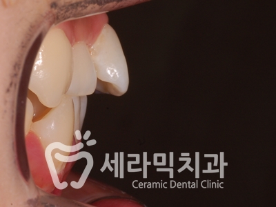 토끼이빨, 틀어진 치아배열 세라믹교정 전후사진 관련 이미지 11