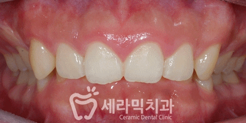 딥바이트 과개교합 치아교정전후 활짝 웃게 된 사례 관련 이미지 4