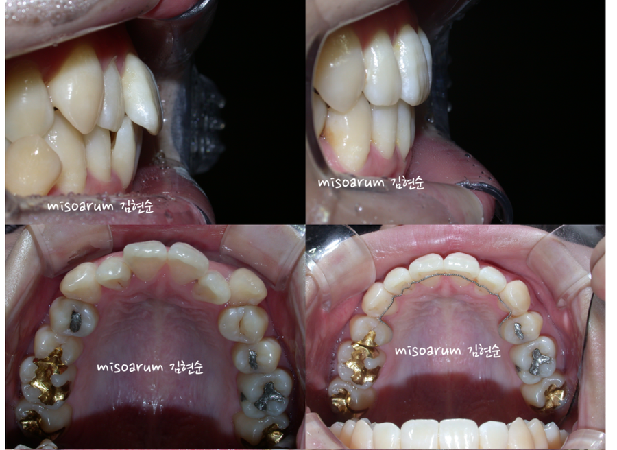세라믹교정 덧니교정 관련 이미지 7
