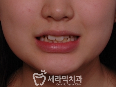 토끼이빨 돌출입 치아교정 전후 표정변화! 관련 이미지 3