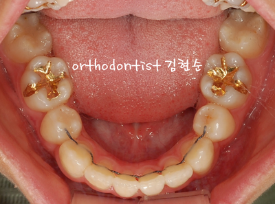 강남 덧니 관련 이미지 26