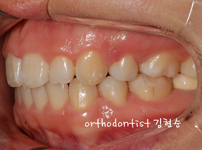 강남 돌출 관련 이미지 31