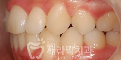 과개교합 치아교정잘하는곳, 세라믹치과 치아교정전후! 관련 이미지 26