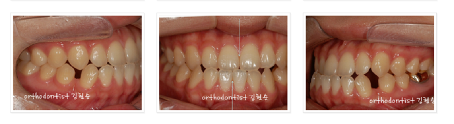 주걱턱수술 안하고 양악수술 안하고 관련 이미지 10