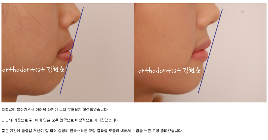 세라믹교정 세라믹치과-돌출입발치교정 6 관련 이미지 8