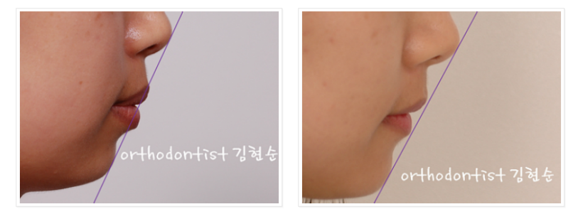 세라믹교정 세라믹치과-돌출입발치교정 7 관련 이미지 9