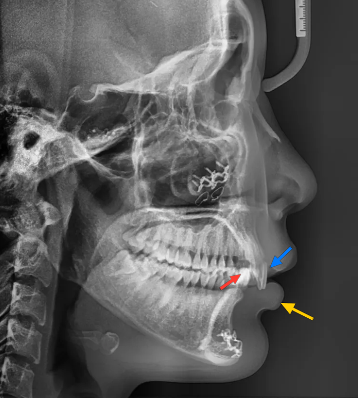 과개교합 교정: 비수술로 치료한 토끼 이빨 이야기 관련 이미지 5