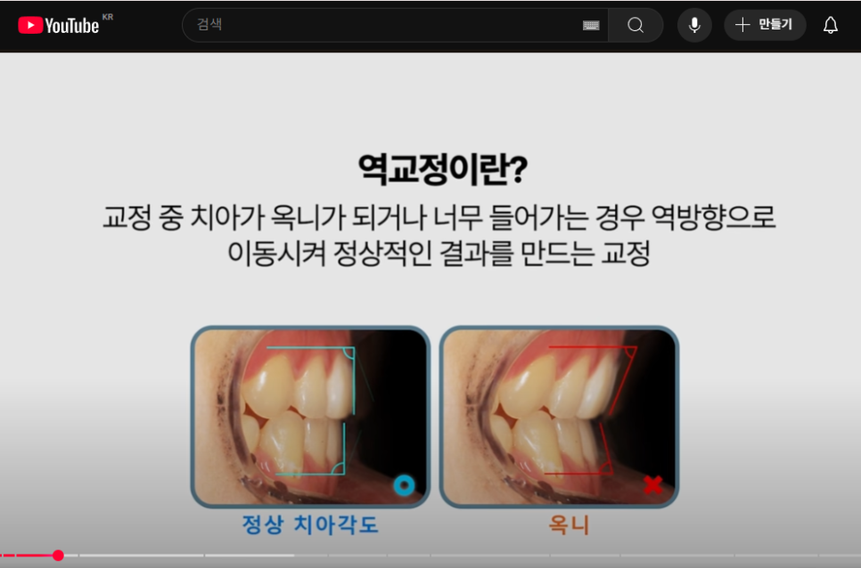 '옥니 역교정' 의미, 치료법, 부작용 알아보기 (+교정치과 선택 Tip) 관련 이미지 2